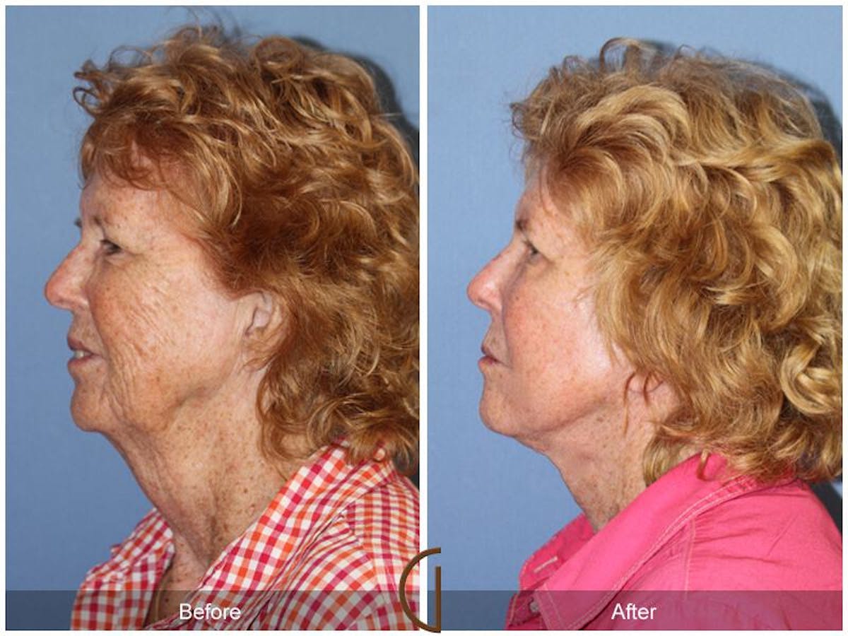 Facelift 70s Before & After Gallery - Patient 399650 - Image 1