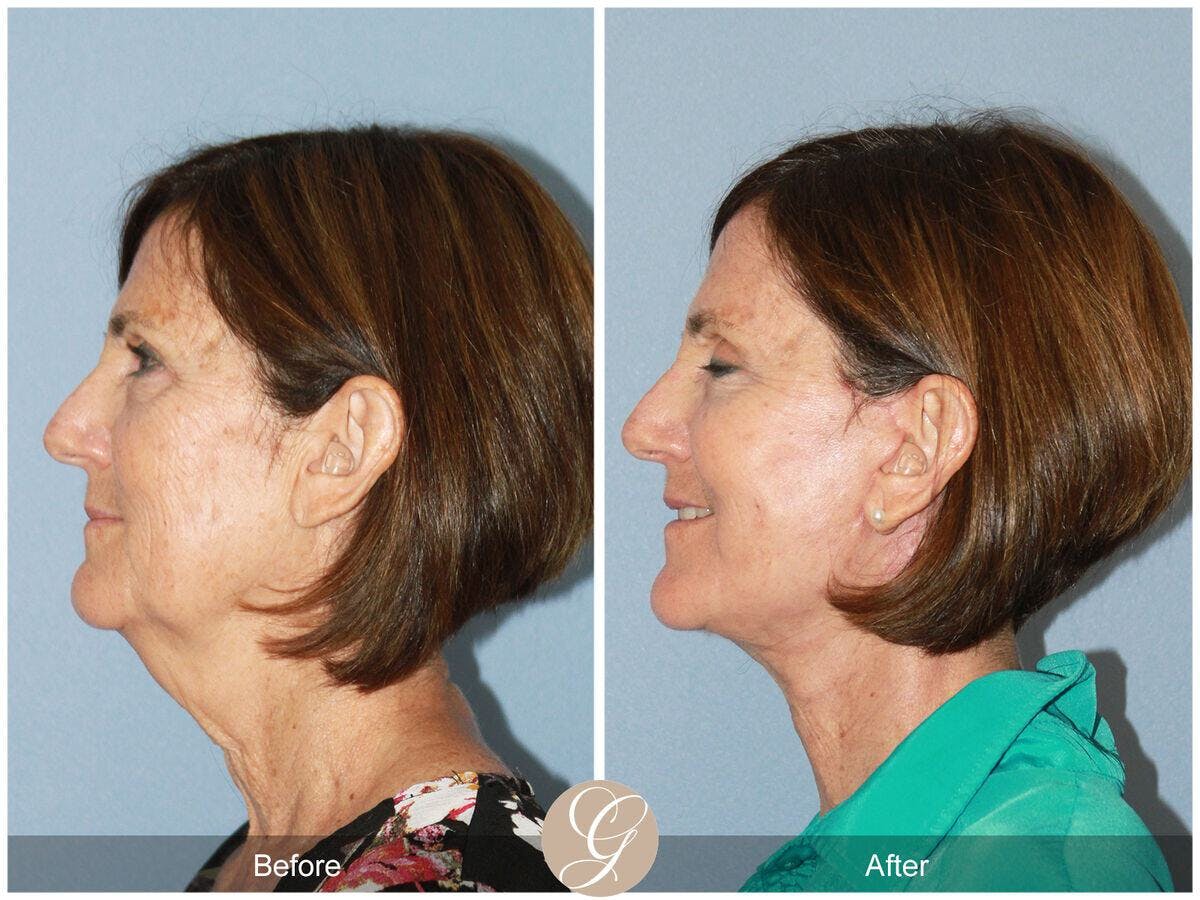 Facelift 60s Before & After Gallery - Patient 341211 - Image 1