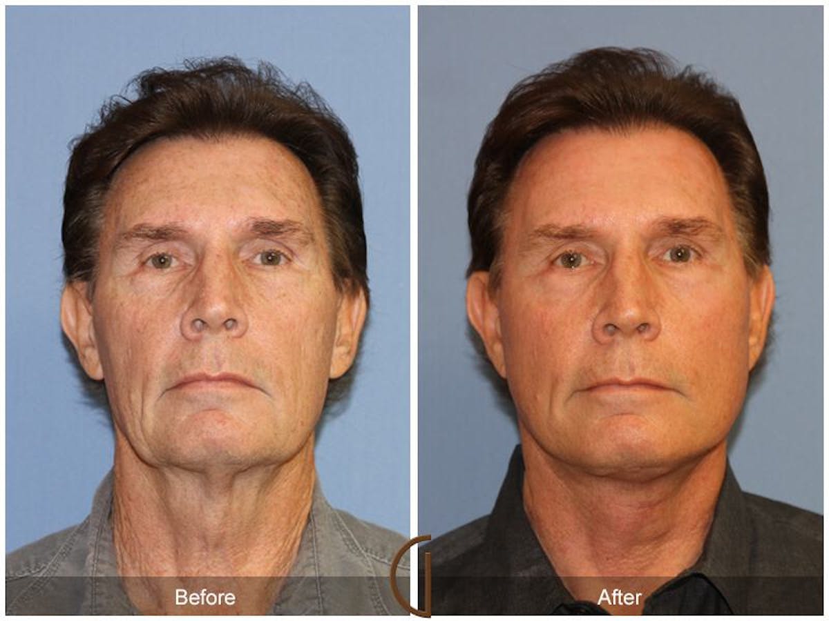 Neck Lift Before & After Gallery - Patient 223662 - Image 2