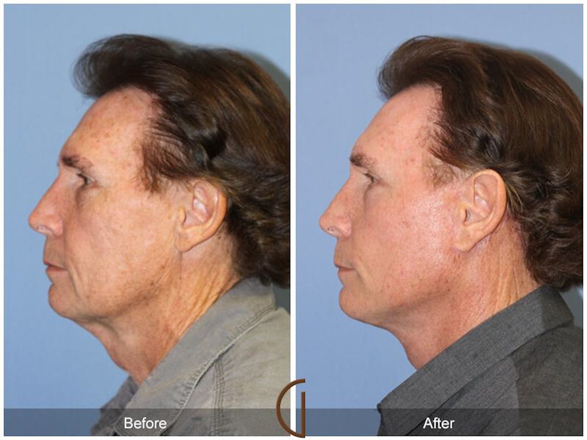 Neck Lift Before & After Gallery - Patient 223662 - Image 1