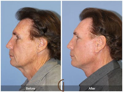 Neck Lift Before & After Gallery - Patient 223662 - Image 1