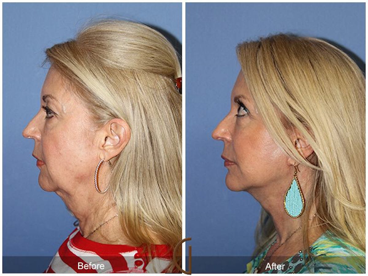 Neck Lift Before & After Gallery - Patient 582012 - Image 1