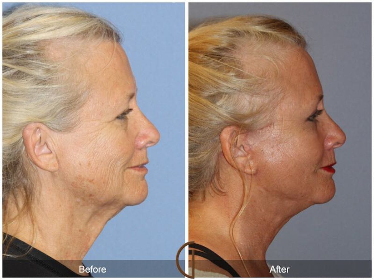 Facelift 60s Before & After Gallery - Patient 414935 - Image 3
