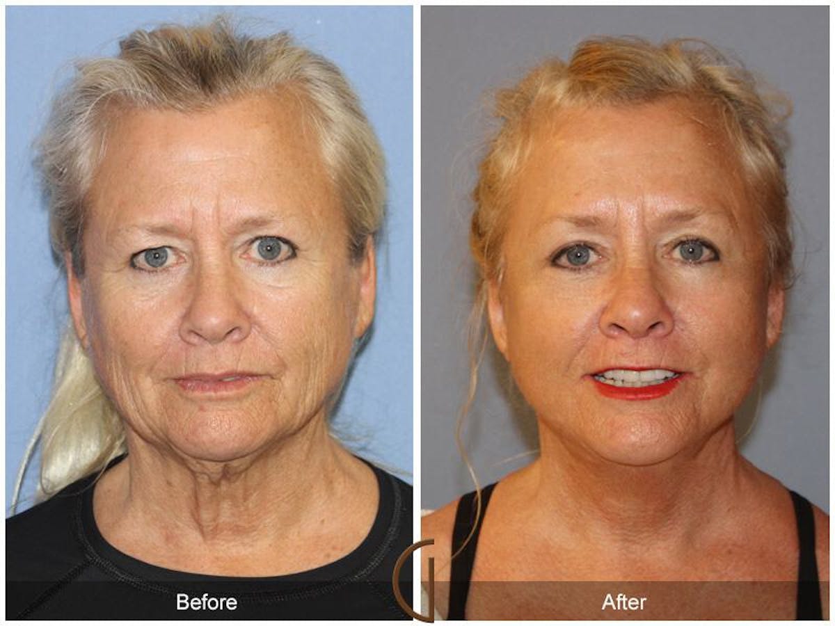 Facelift 60s Before & After Gallery - Patient 414935 - Image 2