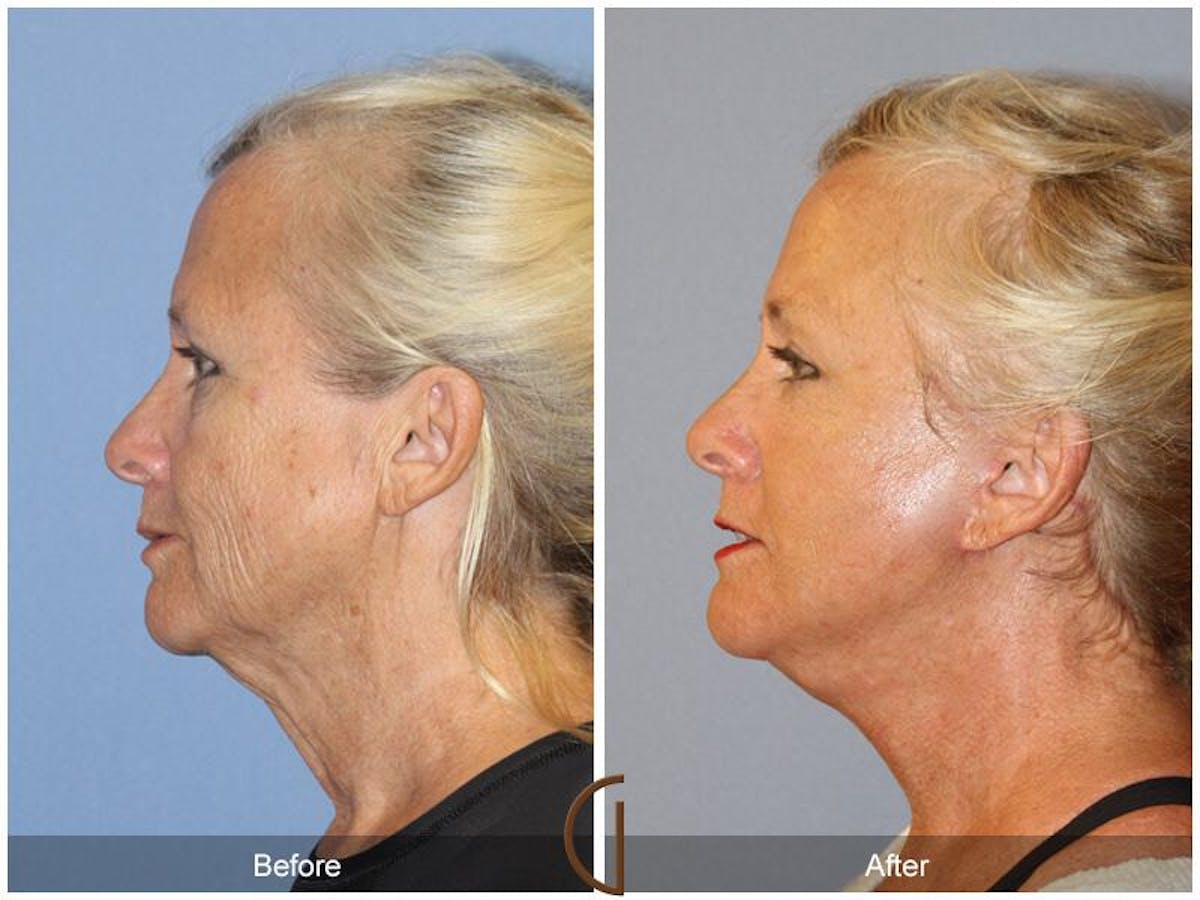 Facelift 60s Before & After Gallery - Patient 414935 - Image 1