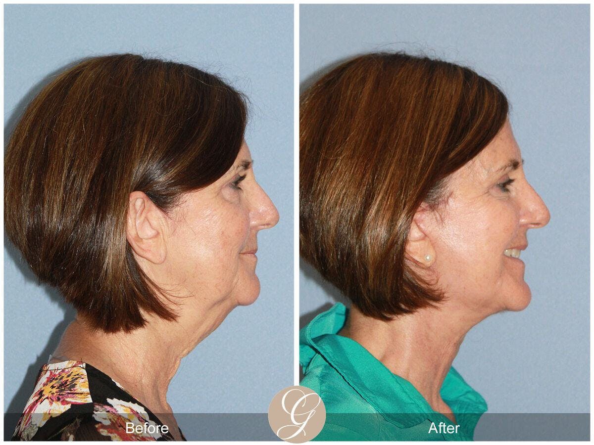 Facelift 60s Before & After Gallery - Patient 341211 - Image 3