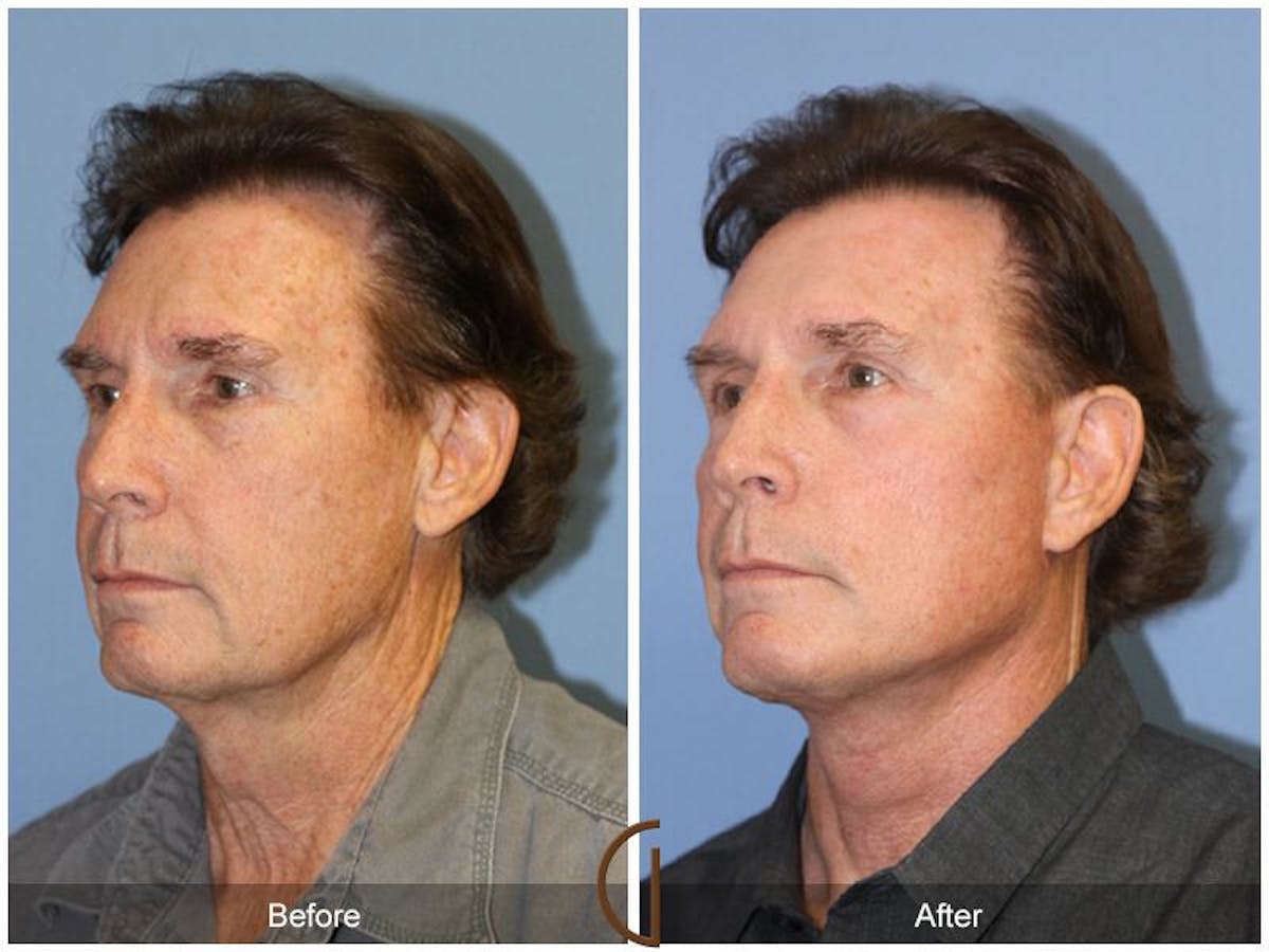 Neck Lift Before & After Gallery - Patient 223662 - Image 3
