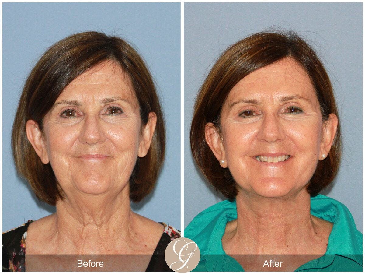 Facelift 60s Before & After Gallery - Patient 341211 - Image 2
