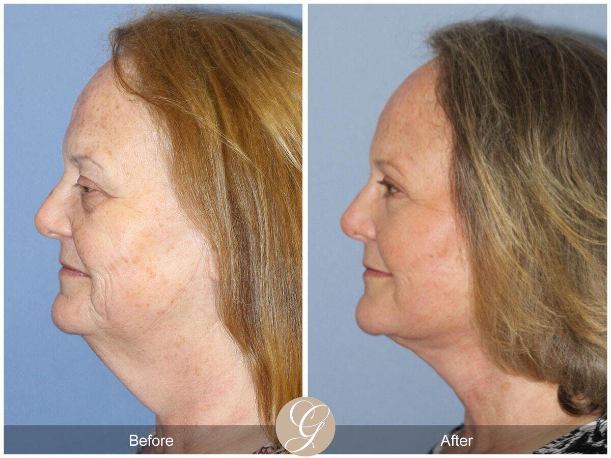 Facelift 60s Before & After Gallery - Patient 314692 - Image 1