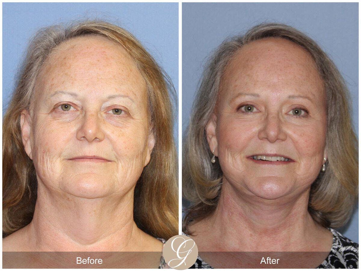 Facelift 60s Before & After Gallery - Patient 314692 - Image 2