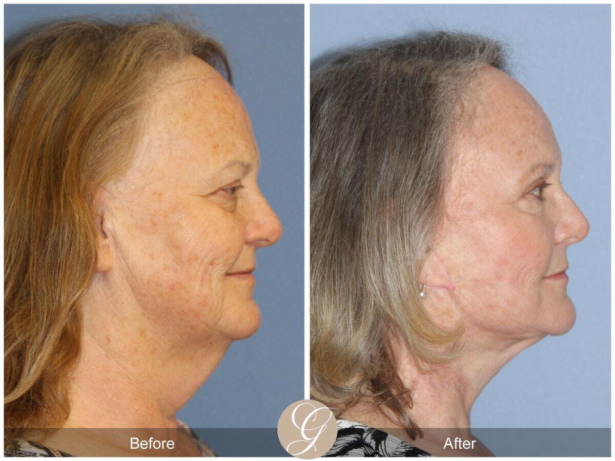 Facelift 60s Before & After Gallery - Patient 314692 - Image 3