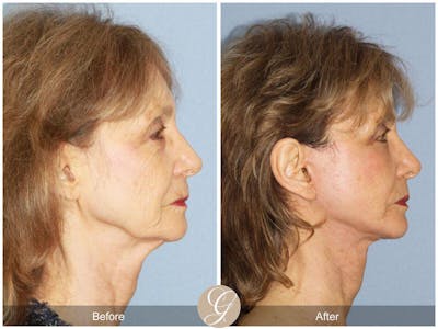 Neck Lift Before & After Gallery - Patient 349627 - Image 1