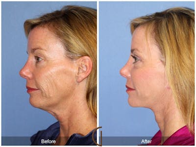 Neck Lift Before & After Gallery - Patient 373822 - Image 1