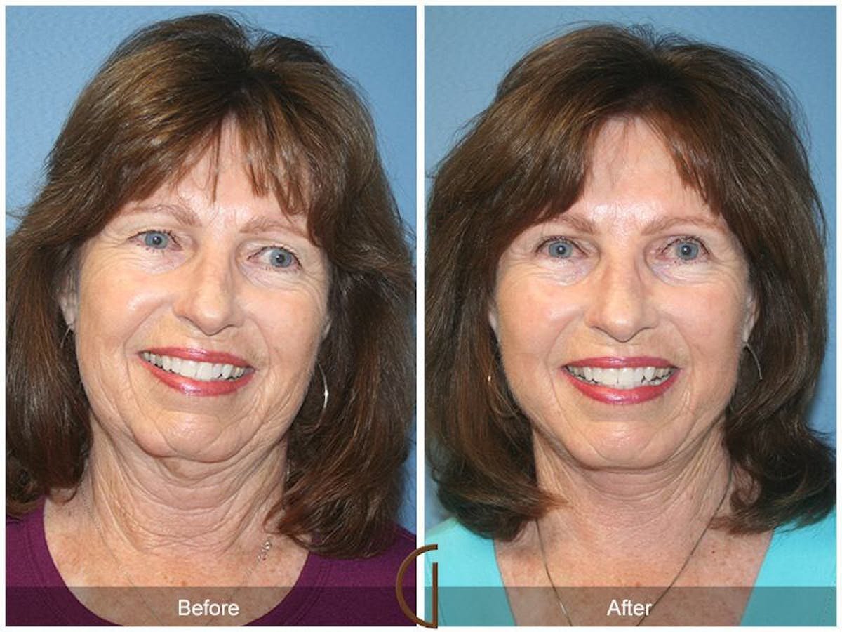 Facelift 60s Before & After Gallery - Patient 166312 - Image 2
