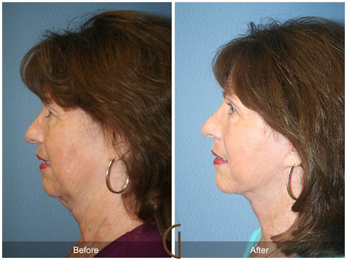 Facelift 60s Before & After Gallery - Patient 166312 - Image 1