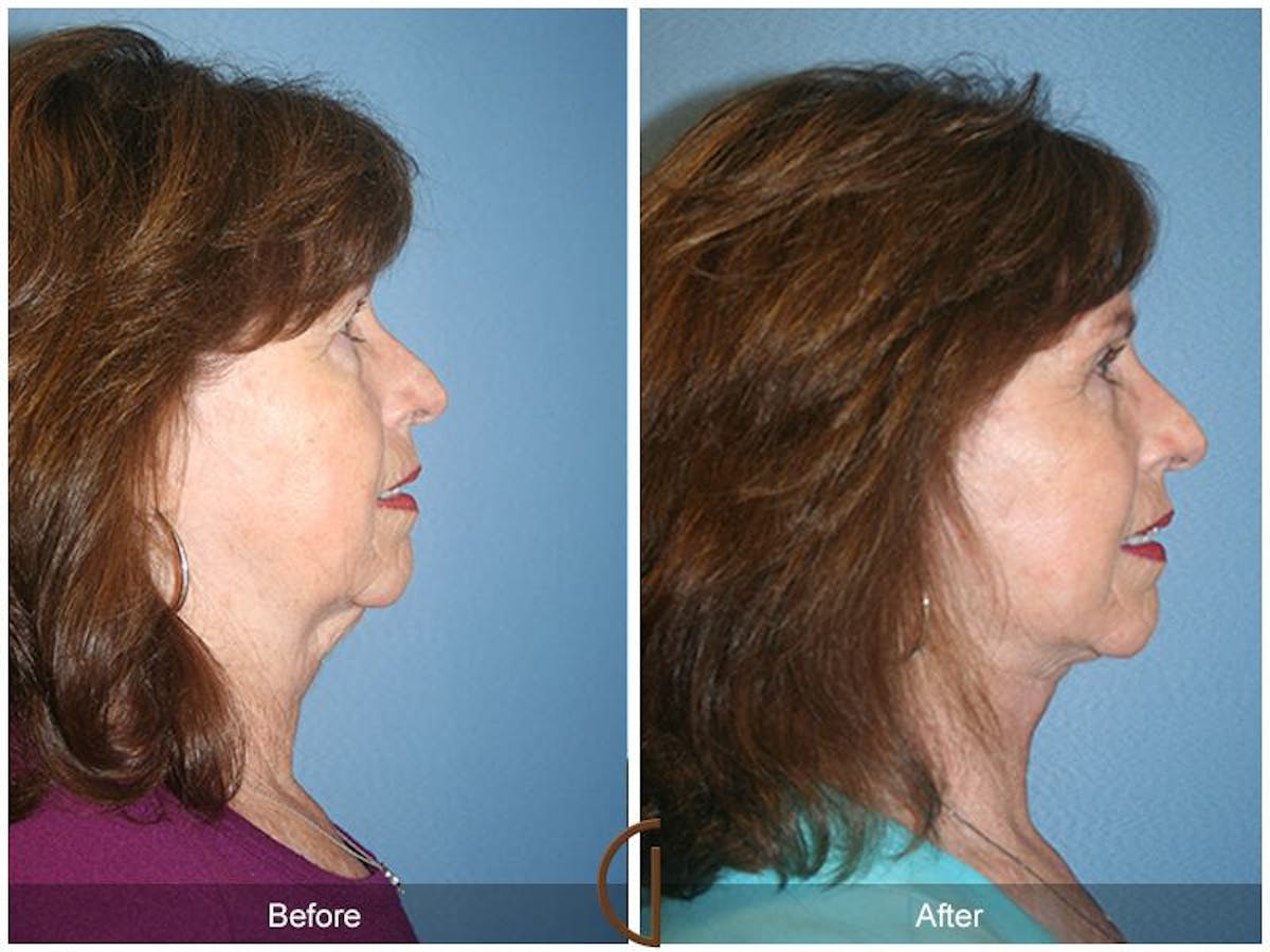 Facelift 60s Before & After Gallery - Patient 166312 - Image 3