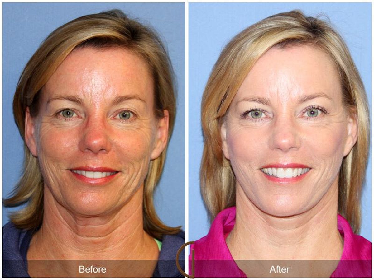 Facelift 40s Before & After Gallery - Patient 419986 - Image 2