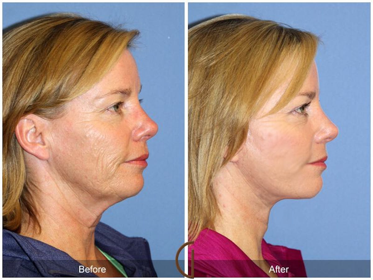 Facelift 40s Before & After Gallery - Patient 419986 - Image 3