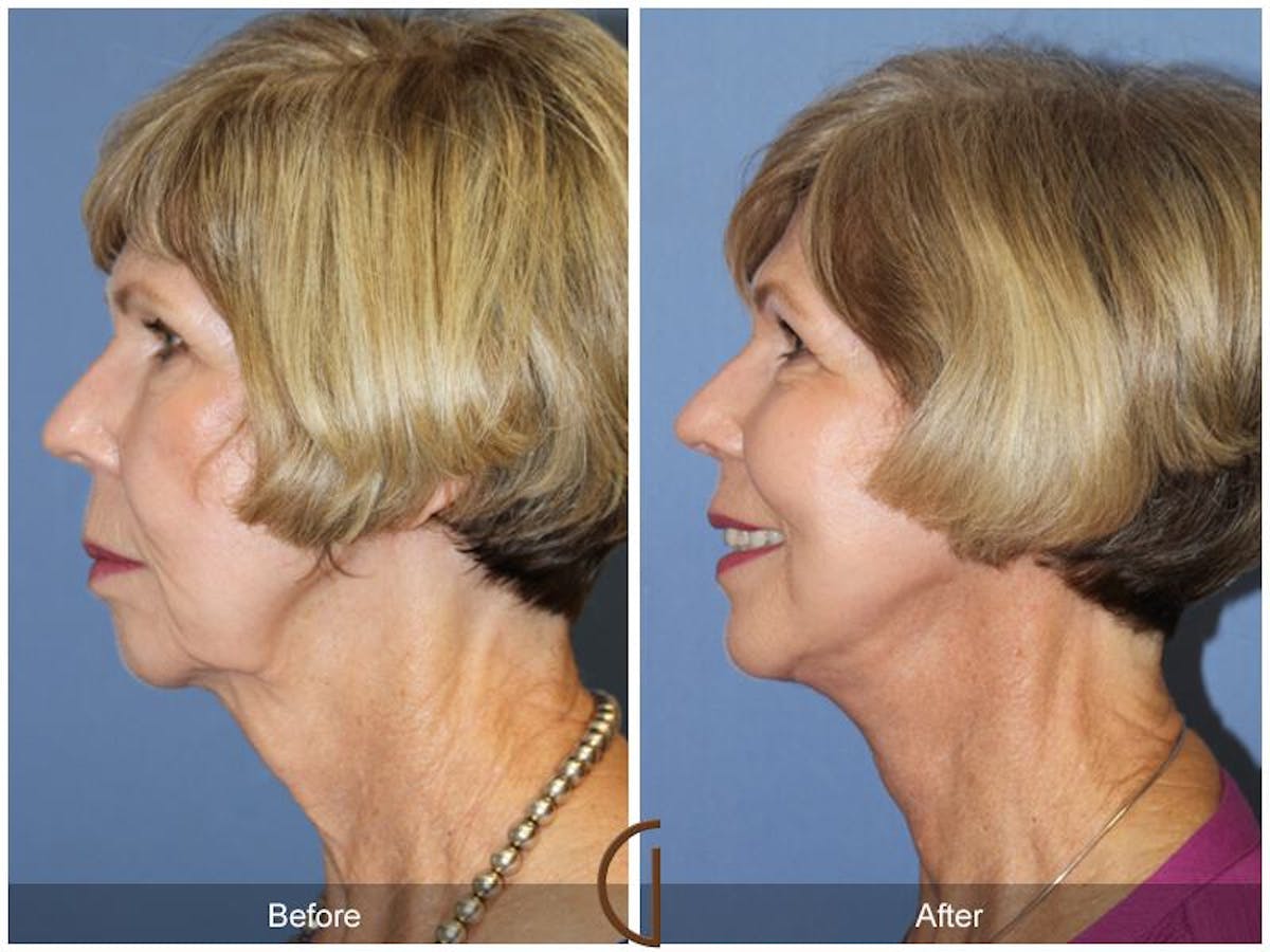 Facelift 60s Before & After Gallery - Patient 417267 - Image 1