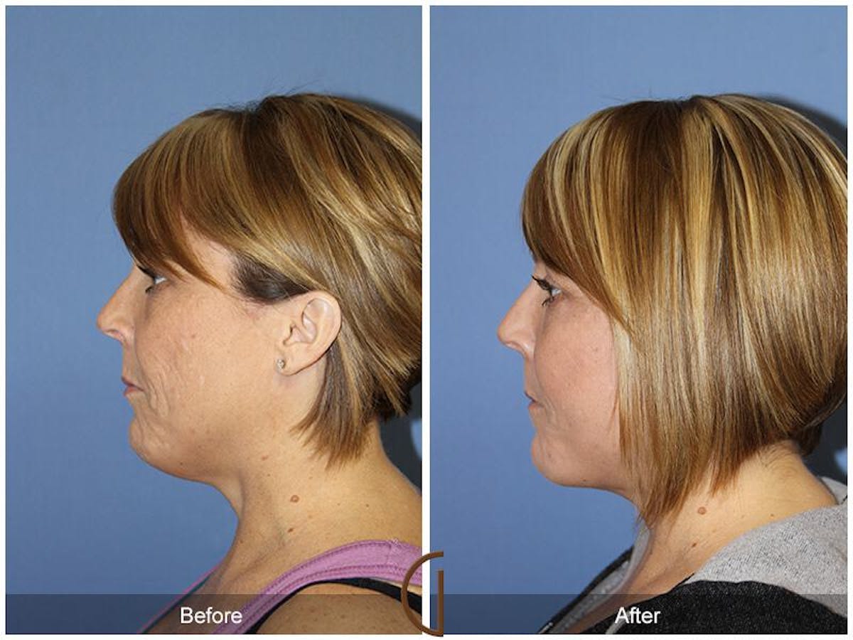 Facelift 40s Before & After Gallery - Patient 858304 - Image 1