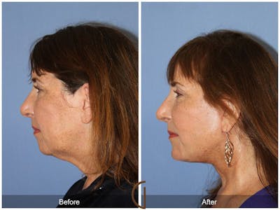 Facelift 50s Before & After Gallery - Patient 374796 - Image 1