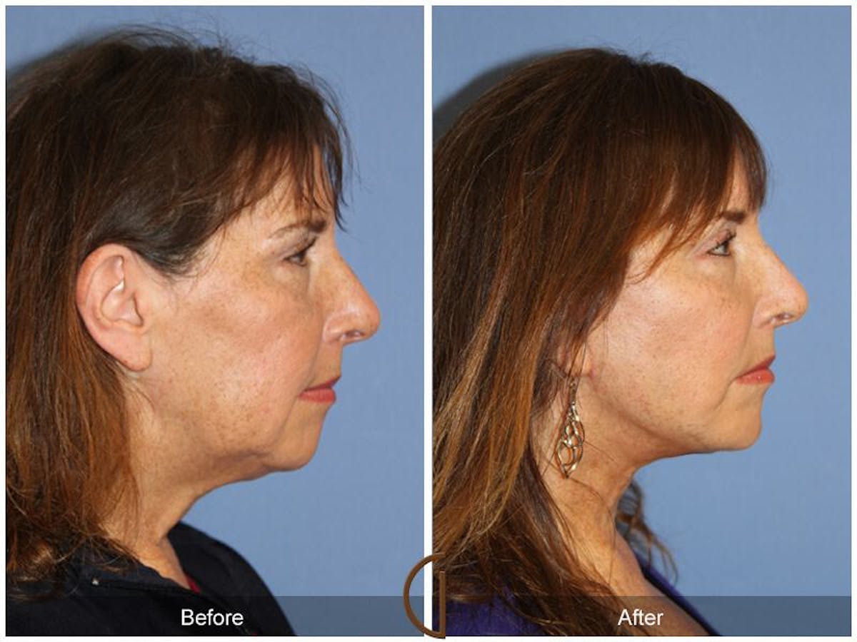 Facelift 50s Before & After Gallery - Patient 374796 - Image 3