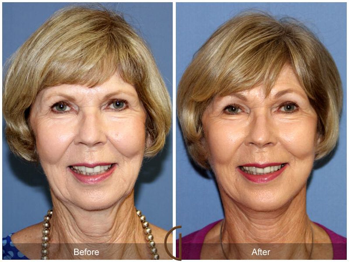 Facelift 60s Before & After Gallery - Patient 417267 - Image 2