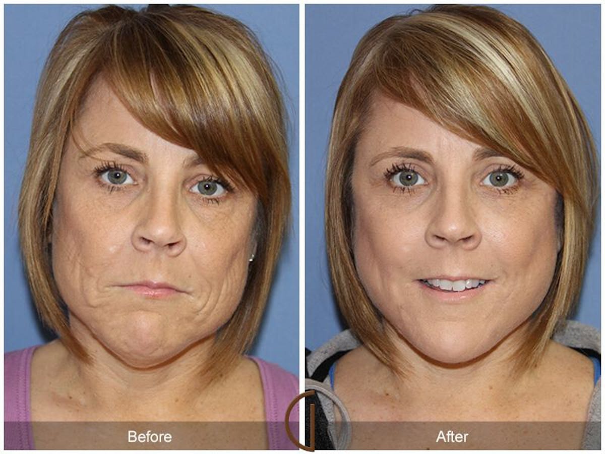 Facelift 40s Before & After Gallery - Patient 858304 - Image 2