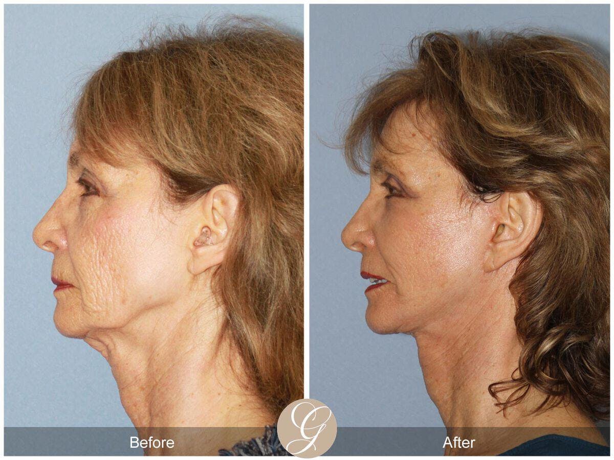 Eyelid Lift Before & After Gallery - Patient 400157 - Image 1