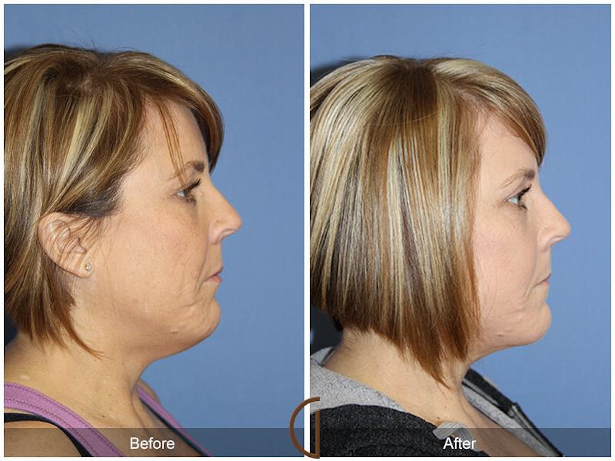 Facelift 40s Before & After Gallery - Patient 858304 - Image 3