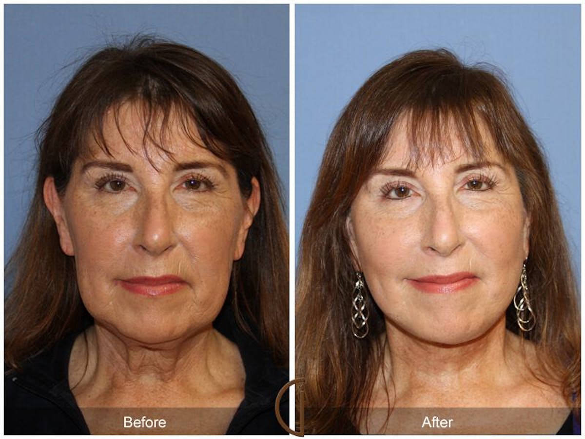 Facelift 50s Before & After Gallery - Patient 374796 - Image 2