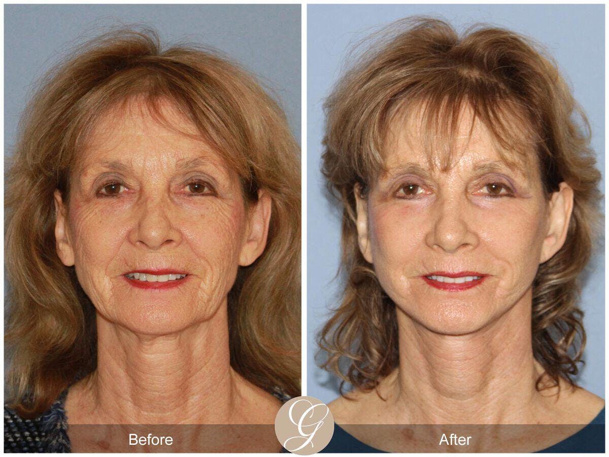 Eyelid Lift Before & After Gallery - Patient 400157 - Image 2