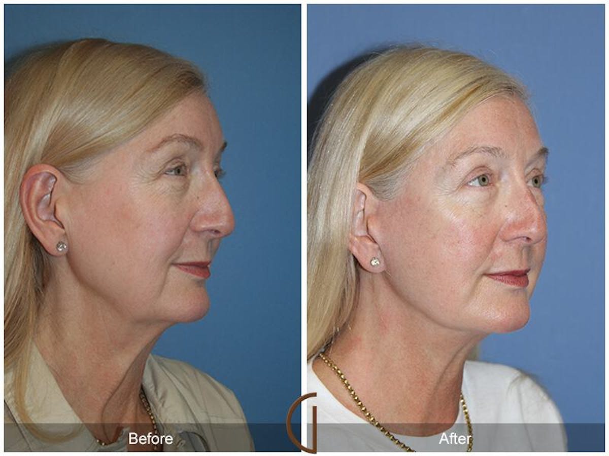 Facelift 60s Before & After Gallery - Patient 359970 - Image 3