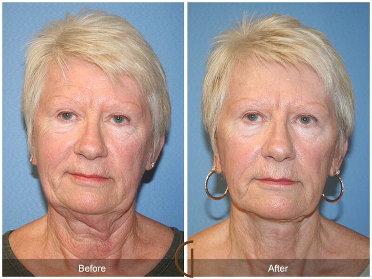 Facelift 60s Before & After Gallery - Patient 256132 - Image 2