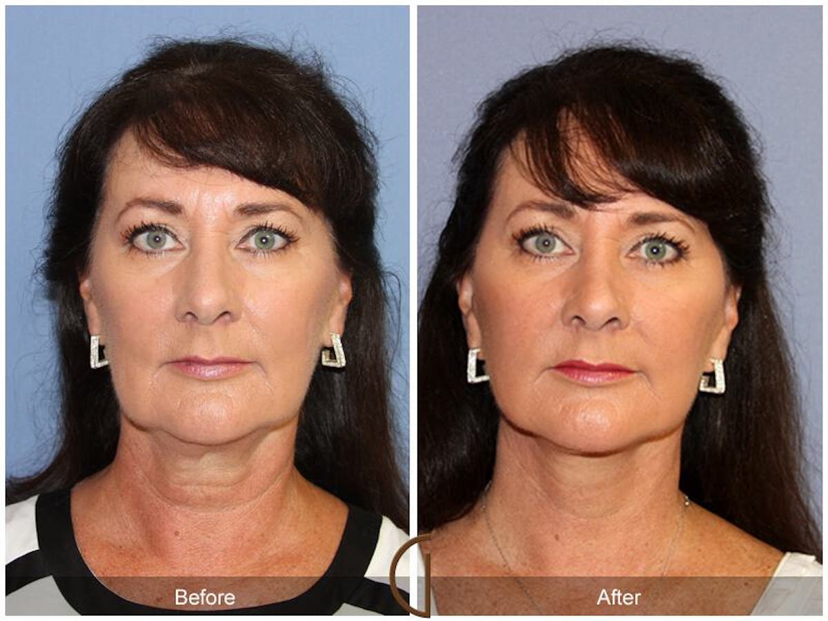 Facelift 50s Before & After Gallery - Patient 200492 - Image 2