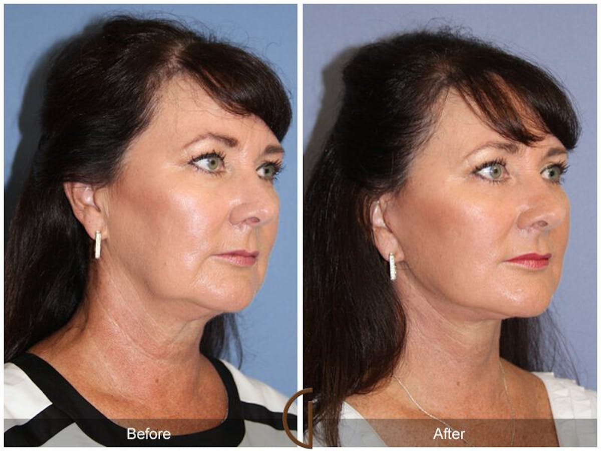 Facelift 50s Before & After Gallery - Patient 200492 - Image 3