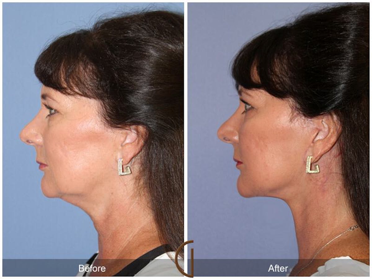 Facelift 50s Before & After Gallery - Patient 200492 - Image 1