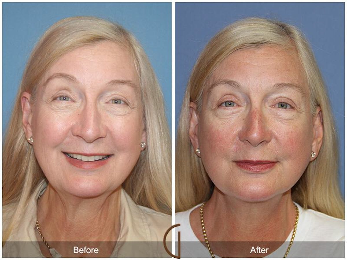 Facelift 60s Before & After Gallery - Patient 359970 - Image 2