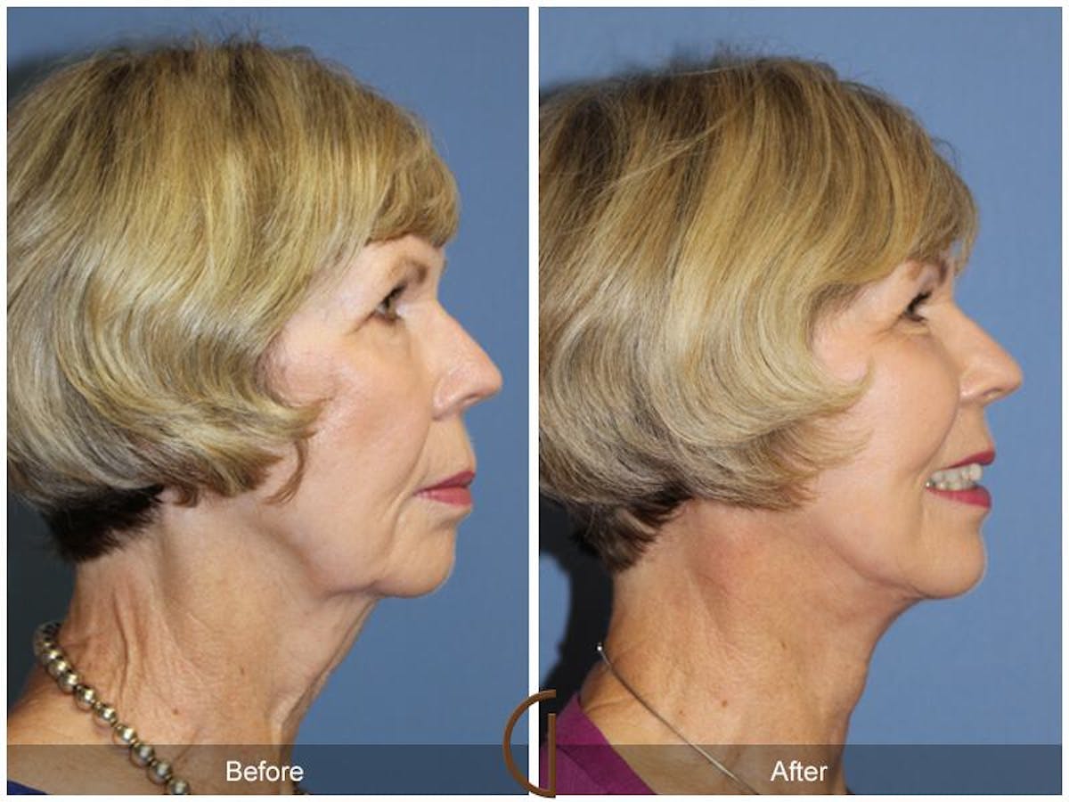 Facelift 60s Before & After Gallery - Patient 417267 - Image 3