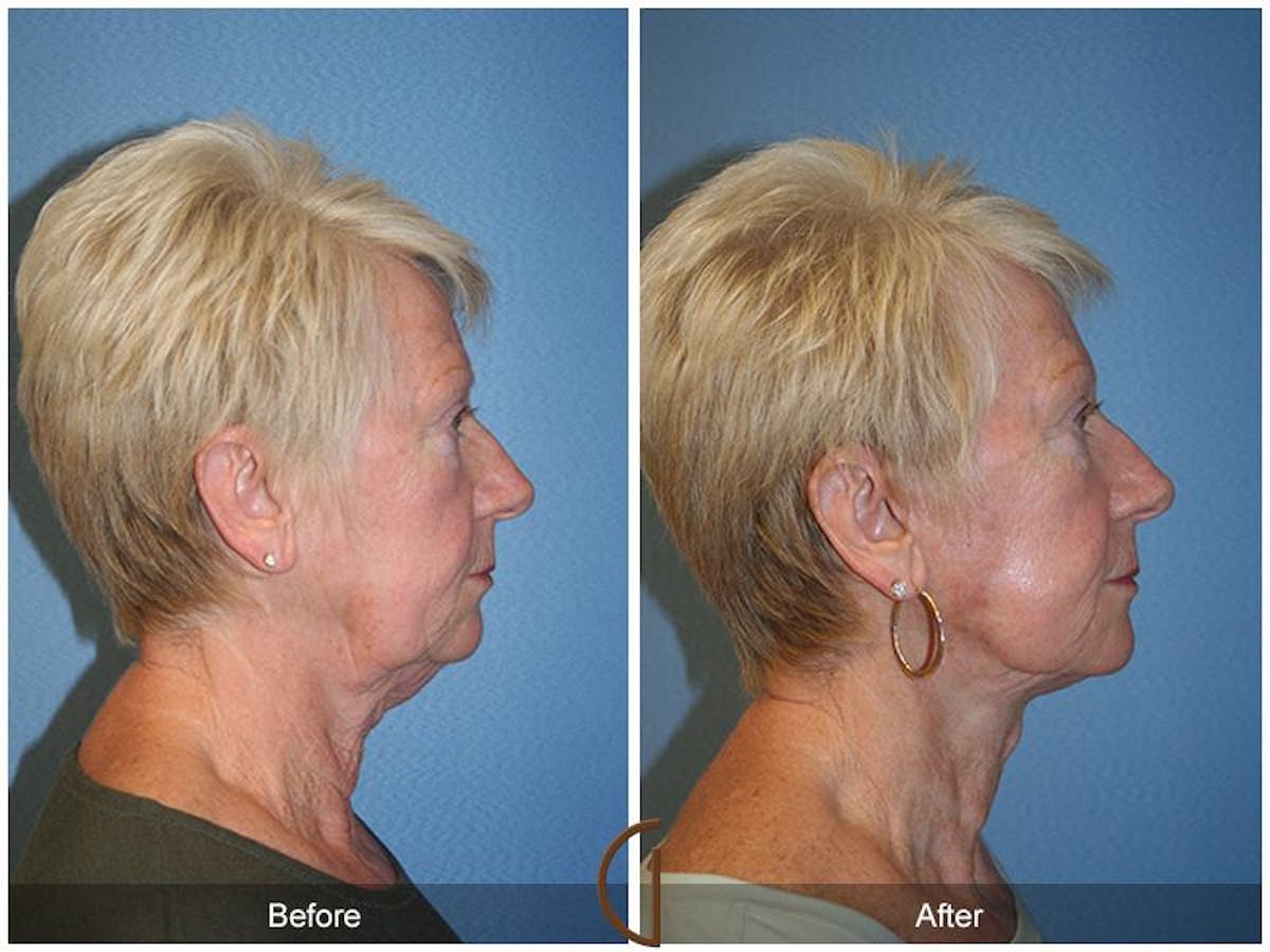Facelift 60s Before & After Gallery - Patient 256132 - Image 3