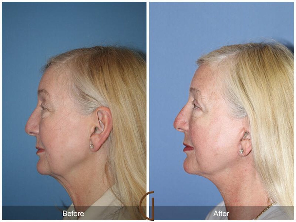 Facelift 60s Before & After Gallery - Patient 359970 - Image 1