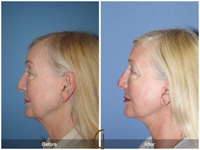 Neck Lift Before & After Gallery - Patient 175411 - Image 1
