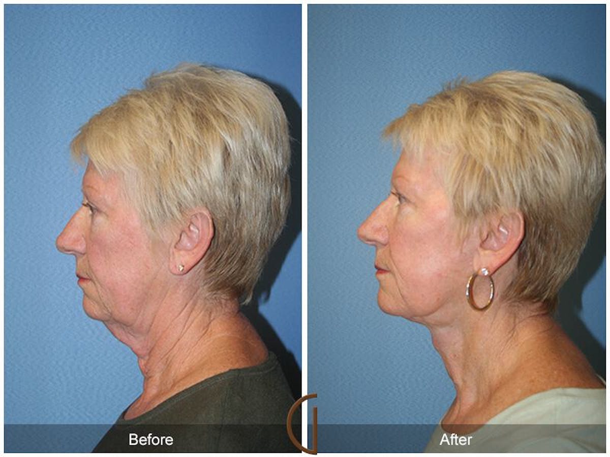 Facelift 60s Before & After Gallery - Patient 256132 - Image 1