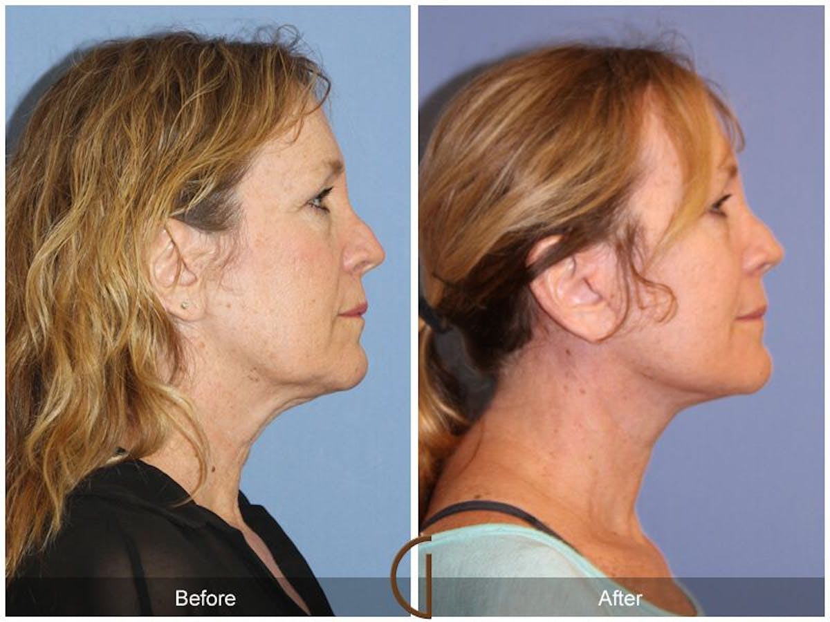 Facelift 50s Before & After Gallery - Patient 173090 - Image 3