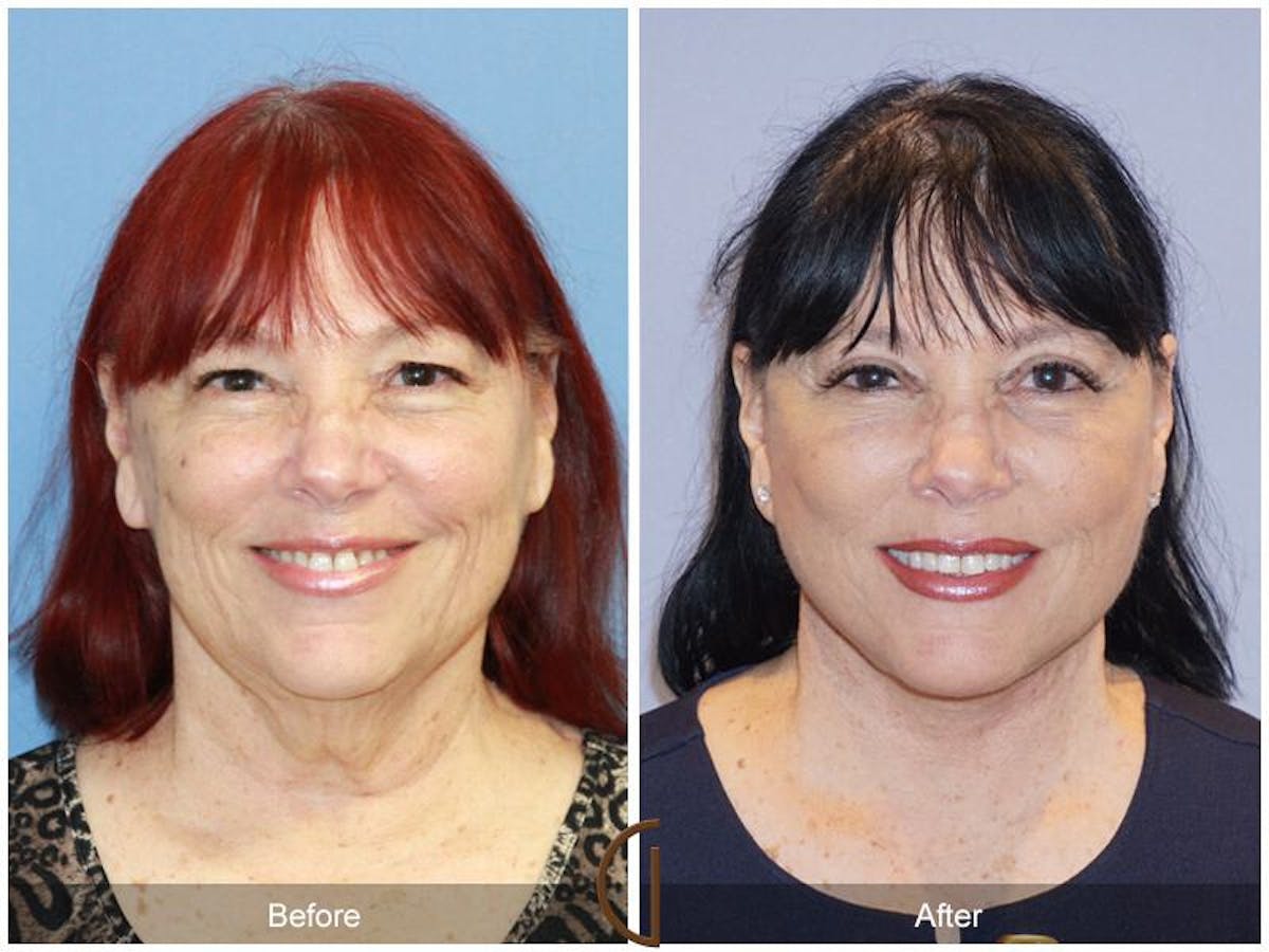 Facelift 60s Before & After Gallery - Patient 318211 - Image 2