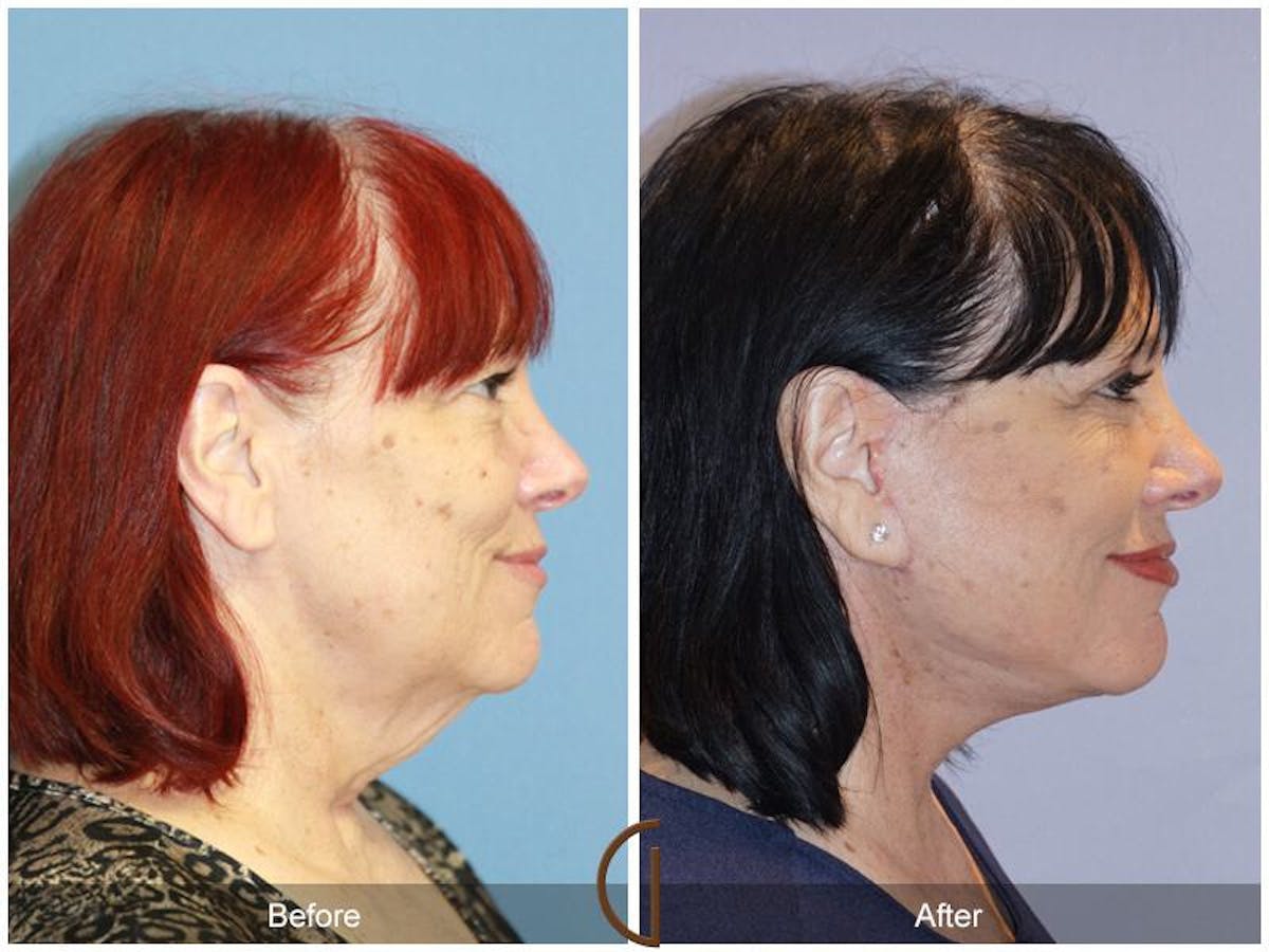 Facelift 60s Before & After Gallery - Patient 318211 - Image 3