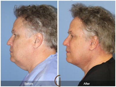 Neck Lift Before & After Gallery - Patient 852987 - Image 1