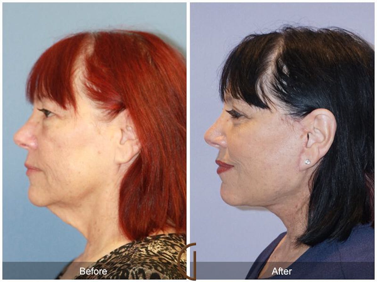 Facelift 60s Before & After Gallery - Patient 318211 - Image 1