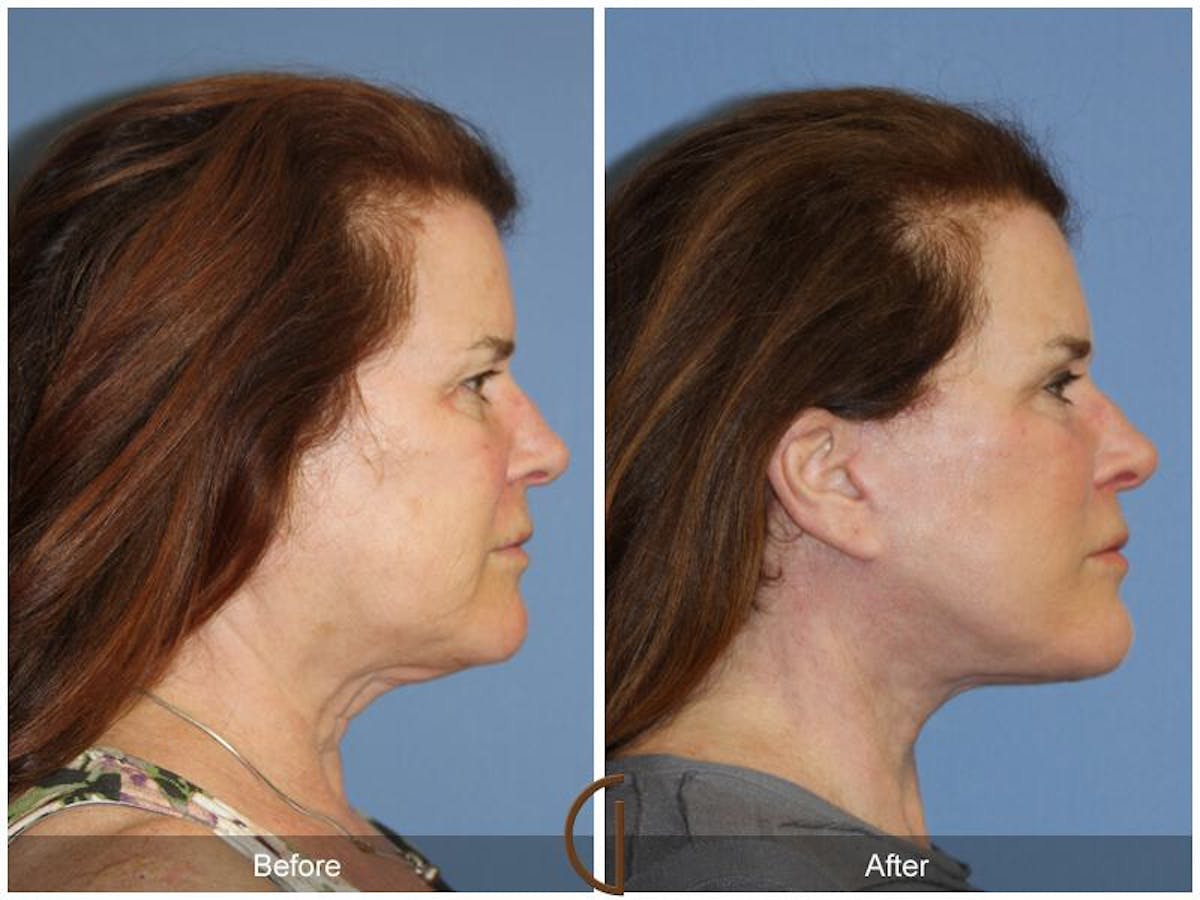 Neck Lift Before & After Gallery - Patient 140843 - Image 3