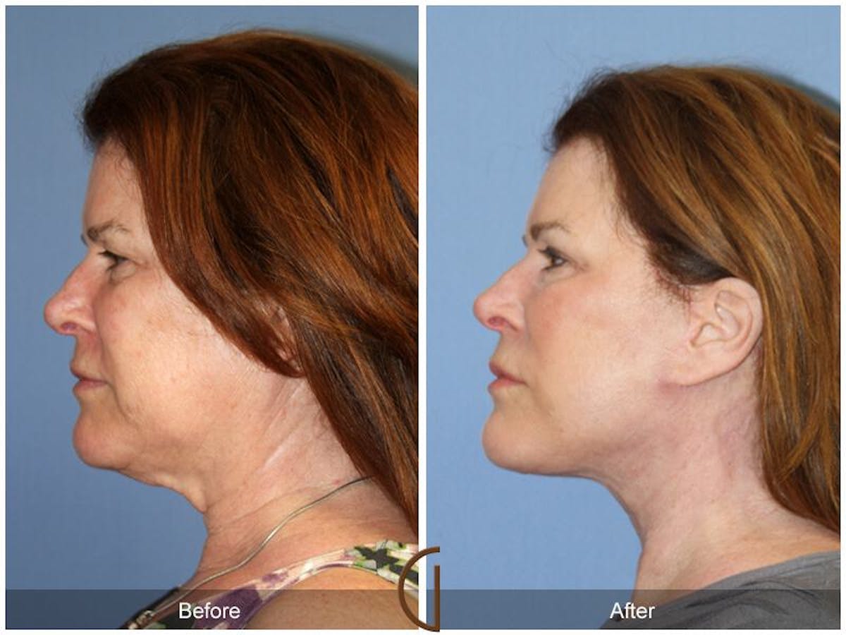 Neck Lift Before & After Gallery - Patient 140843 - Image 1